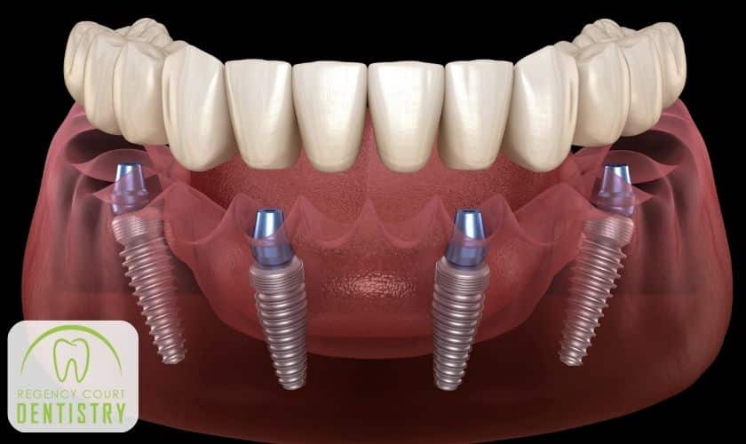 Are you a good candidate for All-On-4 Implant