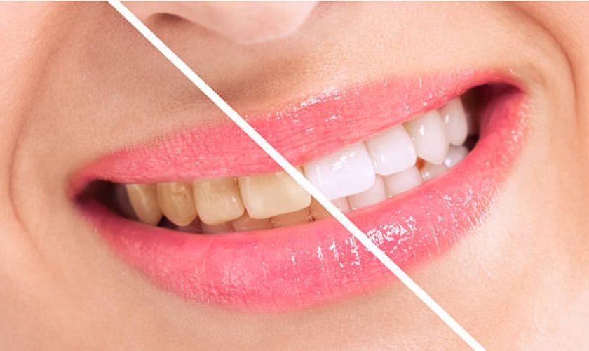 Best Professional Teeth Whiteners: Laser Teeth Whitening Vs  Bleaching