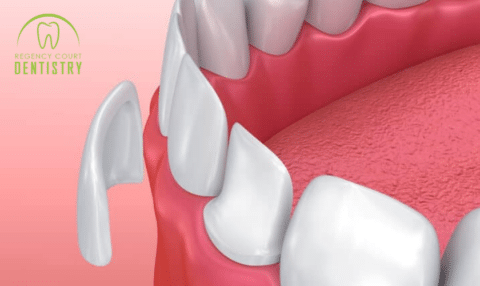 Dental Veneer Aftercare Tips