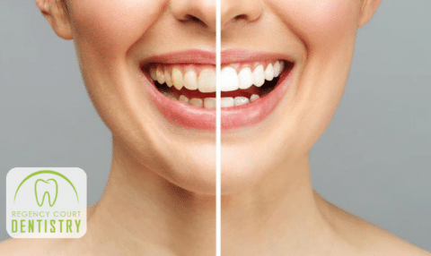 Is Professional Teeth Whitening Worth the Investment?