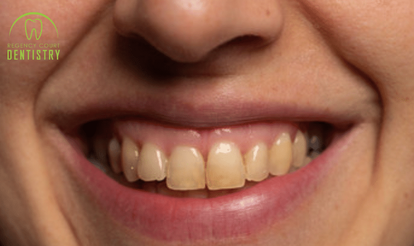 Significant Causes Of Tooth Discoloration