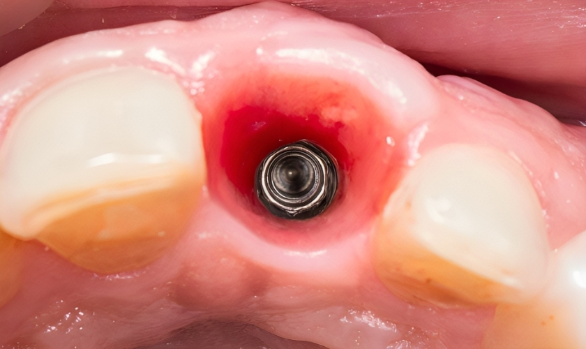 boca raton dentists put patients to sleep for dental implants regency court dentistry explains