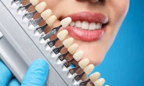 common reasons to replace your dental veneers