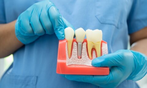 dental implant aftercare