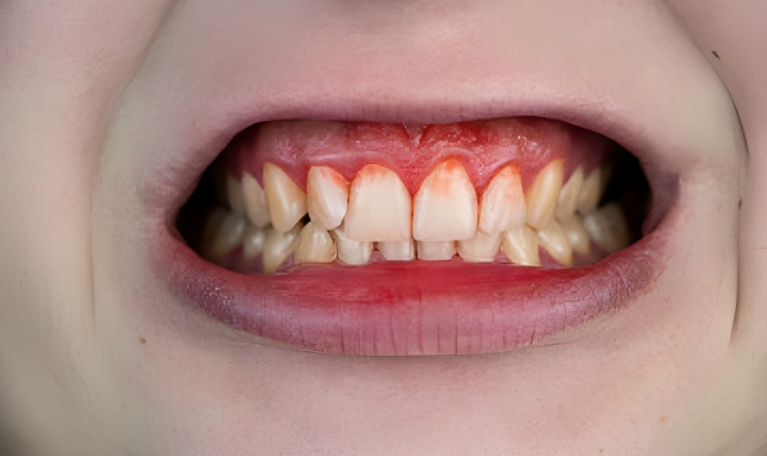 dr naved fatmi dentist boca raton explains what is strawberry gum disease