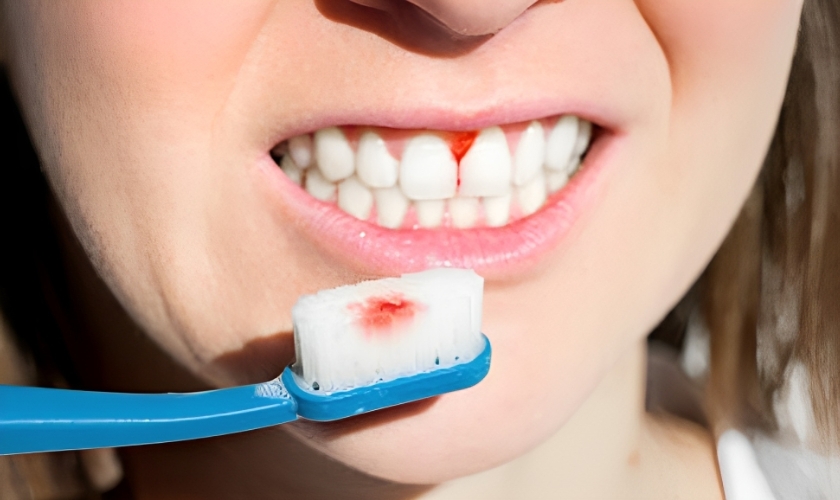 find out what causes bleeding gums with boca raton dentist naved fatmi