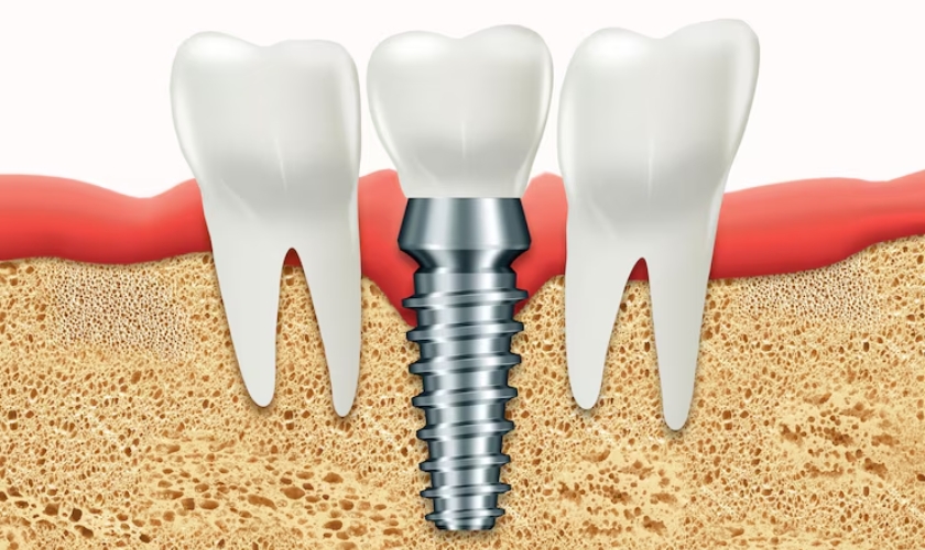 learn about dental implants